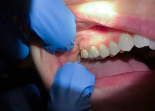 Best Emergency Denture Repair in Osceola, IN